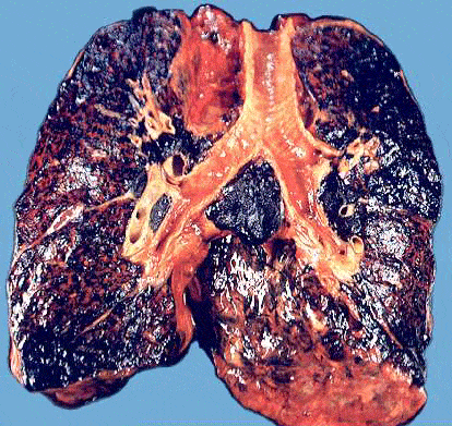 吸烟10年的肺真实图片图片