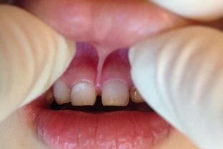 6岁小孩门牙松了给牙医拔掉,2个月都没长出新牙正常吗