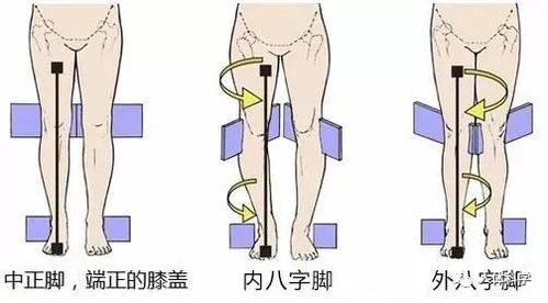 因不良习惯导致的内八字如何改善