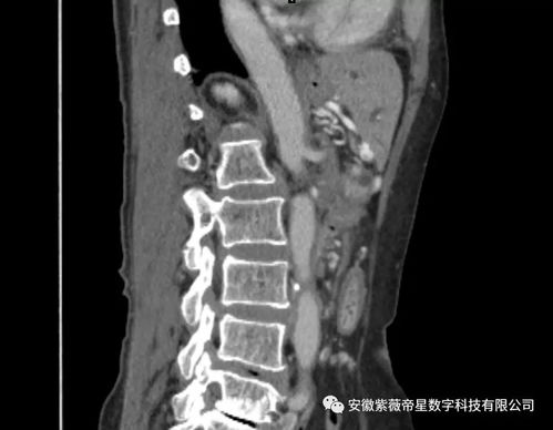 三维可视化技术,让胰腺癌患者享有最佳治疗