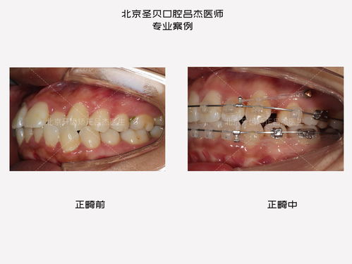 北京牙齿矫正吕杰告诉你 为什么说突嘴女生都是潜力股