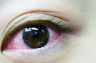 怎样预防红眼病