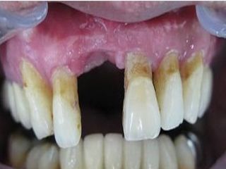 种植牙植入骨粉是什么
