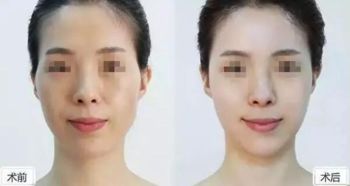 面部填充手术对人体有害吗