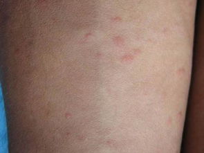 过敏性荨麻疹具有传染性吗