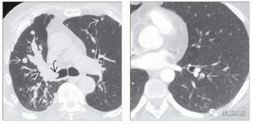 胸部影像诊断图例丨气道病变 良 恶性肿瘤