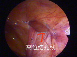 腹腔镜下小儿腹股沟疝气治疗新技术