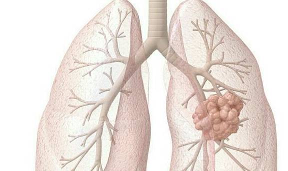 什么样的肺癌才算早期呢 早期能被发现吗 手术后还会复发么
