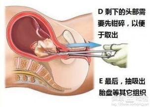 人流后的保养原则有哪些