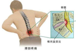 腰椎病究竟是怎么来的 