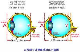 孩子眼睛变形,难道都是眼镜惹的祸