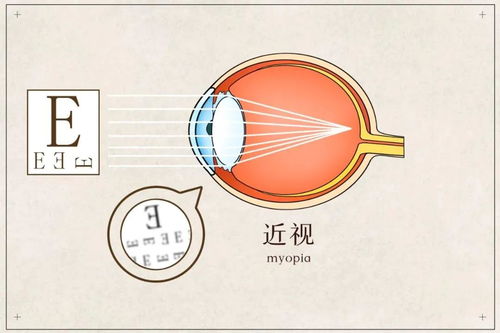 晶视达视力 假性近视若不及时矫正,多久会发展为真性近视