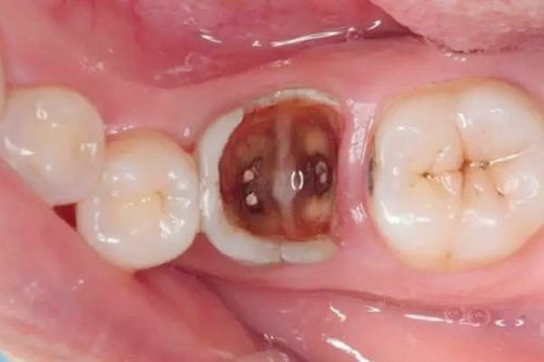 杭州根管治疗一颗牙多少钱 前牙根管600后牙根管865显微根管1000