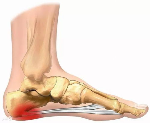 足跟疼痛行走加剧 注意 你可能患了足底筋膜炎