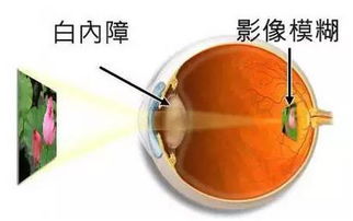 固原眼科 白内障是常见的老年人眼病