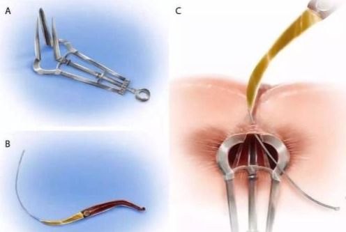 肛瘘微创治疗常见问题