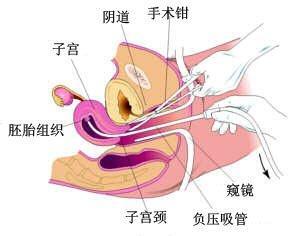 人工流产综合症的介绍 