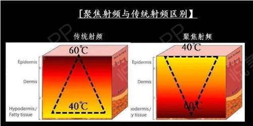 热拉提仪器减肥水果排行榜安全有效的抗衰老项目有哪些 