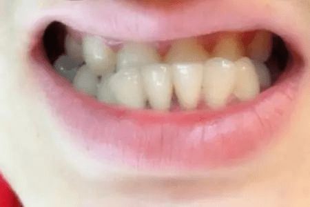 儿童牙齿没换完不用矫正 其实