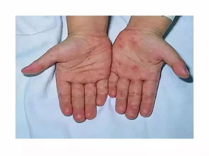 小孩手足口病症状 小孩子手足口病的具体症状有哪些