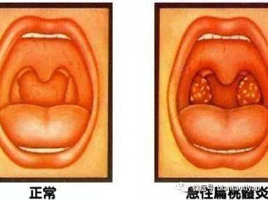 使小孩子扁桃体反复发炎化脓的原因是什么有没有什么特效方法