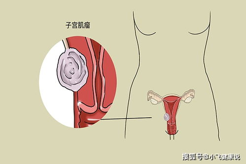 子宫肌瘤和吃有关 滋养 肌瘤的几种食物,女人需少吃