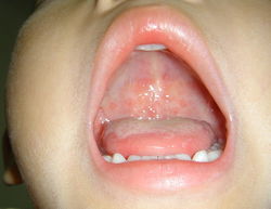 口腔炎的症状,口腔炎的症状图片