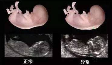 原来孕早期的NT检查这么重要 教你读懂首次产检报告,明明白白爱宝宝
