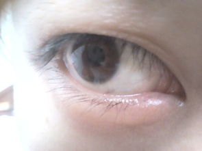 右眼眼角 大眼角 下面长了一个红疙瘩很疼,很痒,跟肿了似的,怎么办 