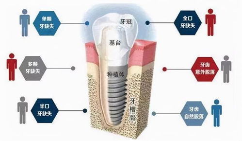 良心医生不建议种植牙 你觉得呢