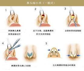 鼻头缩小术 搜狗百科 