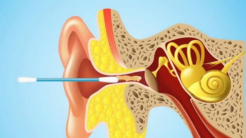 为何不建议用棉签掏耳朵 动画模拟棉签采耳部分过程,原因一目了然 