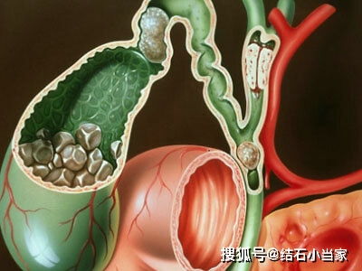 保胆取石 胆结石治疗的最佳选择