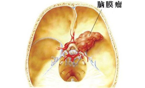 查体查出 脑膜瘤 ,这是癌症吗 还能活多久