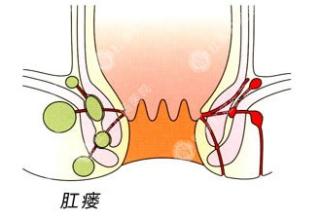 肛瘘可以不手术吗