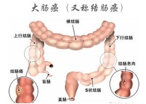 怎么预防大肠癌有效果 