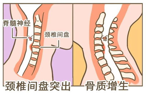 星医百 落枕,是脖子在喊救命