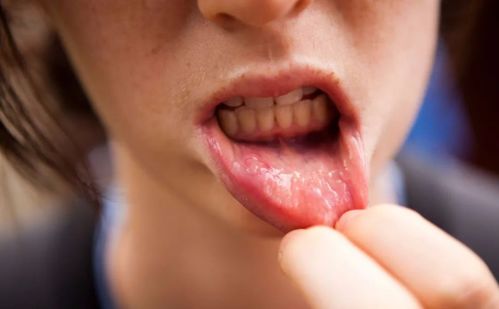 口腔溃疡怎么办 老中医教你六个防治小办法