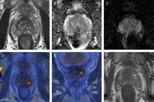 PET MR在前列腺癌诊断中的应用