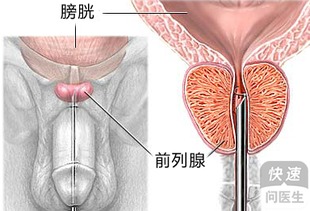 5大原因诱发前列腺炎,前列腺炎的食疗方