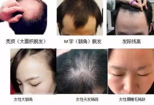 毛发种植小知识(常见毛发种植技术有哪几种)，如何毛发种植小知识(常见毛发种植技术有哪几种)