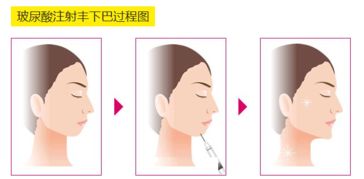 垫下巴都有什么方法 哪种方法垫下巴比较好