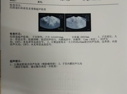 左侧卵巢囊肿在全麻插管下经腹腔镜剔除术一例