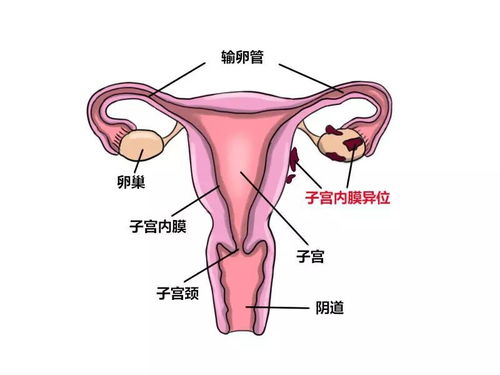子宫内膜异位症(子宫异位症是什么)
