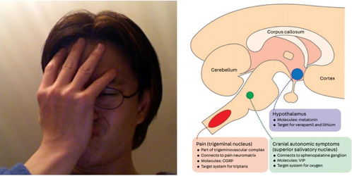 看到 伴流泪的单侧眶周头痛 不要只想到 丛集性头痛