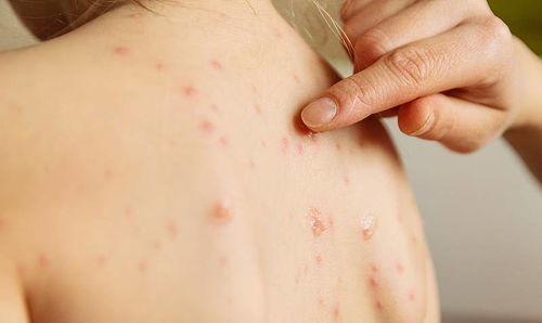 单纯疱疹病毒感染,常发病在皮肤表面,有传染性,有症状便就医