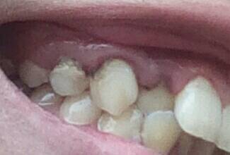 牙齿旁边有黑色的东西是什么东西