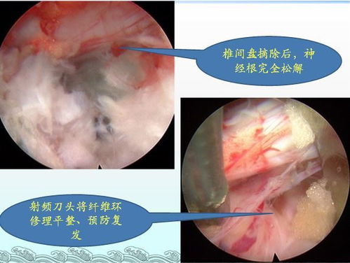 微创椎间孔镜技术治疗腰椎间盘突出