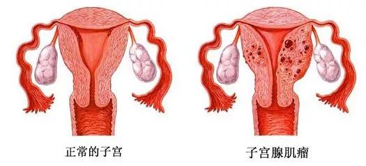 子宫肌瘤怀孕难？提升试管成功率该怎么办？