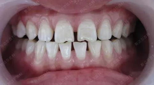 牙齿缝隙大 漏财 6个小方法解决牙缝大问题 